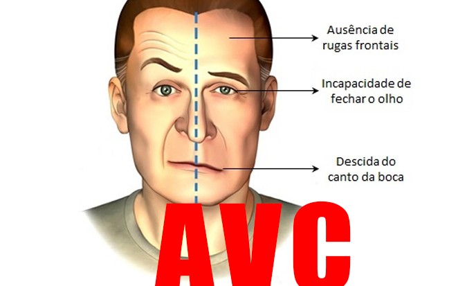 Santa Casa realiza ações pela prevenção e tratamento do AVC